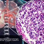 Mengenal Adenokarsinoma – Jenis Kanker Serviks